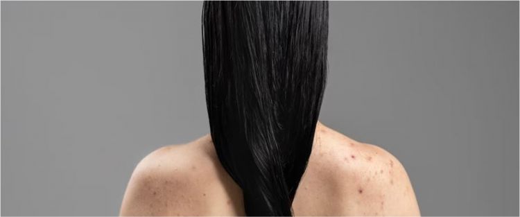 Cara mengatasi jerawat punggung dan bekasnya agar kulit kembali halus ini cuma pakai 2 bahan dapur