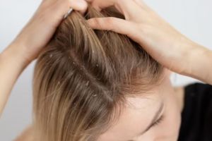 Hanya pakai 2 bahan dapur, begini trik membuat scalp scrub untuk atasi ketombe dan gatal di kepala