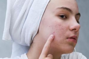 Cuma butuh 3 bahan dapur, begini trik merawat kulit acne prone agar wajah mulus dan bebas jerawat