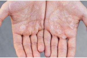 Cegah kulit bersisik, ini 10 cara mengatasi kulit tangan kering yang wajib kamu tahu