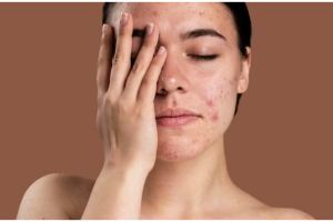 9 Cara merawat kulit berjerawat agar cepat kempes, hindari penggunaan scrub