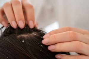 Trik membersihkan ketombe kering ini hanya butuh 2 jenis minyak alami, bantu atasi gatal di kepala