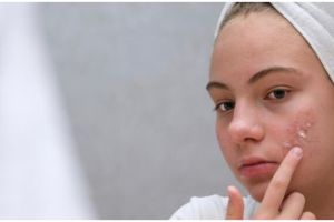 Bikin wajah mulus, ini 9 rekomendasi obat jerawat untuk ibu hamil harga mulai Rp 40 ribuan