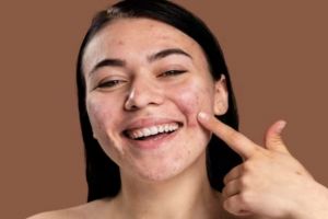 Cuma pakai 2 bahan dapur, begini cara mengatasi jerawat membandel agar wajah kembali mulus