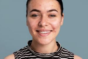 Hanya pakai 2 bahan dapur, begini cara atasi jerawat meradang agar wajah kembali halus dan cerah