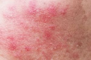 Trik atasi wajah iritasi hanya pakai 2 bahan alami, bikin glowing dan antikering