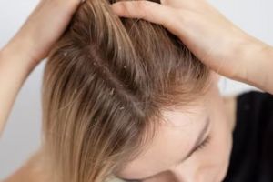 Bantu atasi ketombe dan redakan gatal, begini cara membuat sunflower oil sendiri di rumah