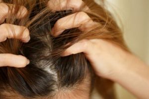 Cara atasi psoriasis pada kulit kepala ini hanya pakai 3 bahan alami, hilangkan gatal dan cegah rontok