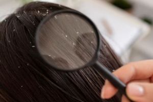 Trik menghilangkan kutu dan atasi ketombe ini hanya pakai 5 bahan alami, bikin rambut auto bersih