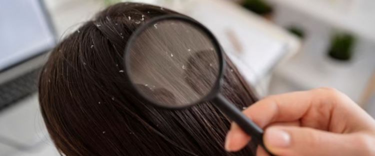 Trik menghilangkan kutu dan atasi ketombe ini hanya pakai 5 bahan alami, bikin rambut auto bersih