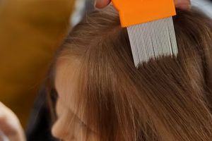 Bebas gatal, begini trik hilangkan kutu rambut hanya pakai 3 bahan dapur