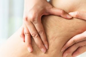 Kulit auto mulus dan cerah, begini cara menghilangkan selulit pakai body mask dari 3 bahan alami