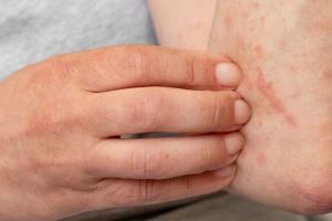 Tak hanya pakai bawang putih, begini trik hilangkan keloid hanya pakai 1 jenis buah