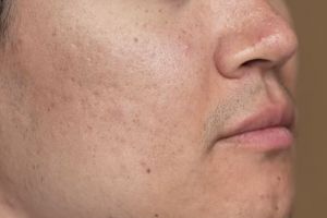 Trik mengecilkan pori-pori hanya pakai toner dari 1 bahan makanan ini bikin wajah auto mulus