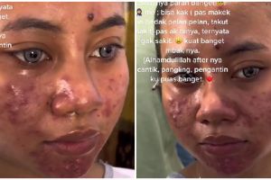 Pengantin berjerawat tampak mulus dan glowing usai dirias MUA ini bikin pangling, disebut mirip Barbie