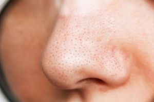 Cuma pakai 4 bahan alami, begini cara menghilangkan komedo dan kulit kusam agar wajah cerah berseri