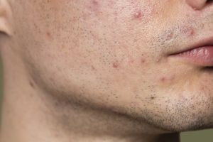 Nggak perlu acne spot care, ini trik atasi jerawat membandel hanya pakai 3 bumbu dapur
