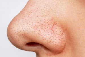 Wajah auto mulus, begini trik hilangkan komedo hitam membandel hanya pakai 2 bahan dapur