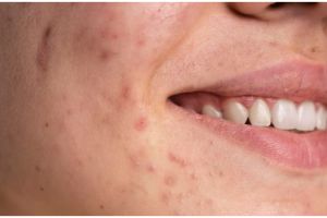 Cerahkan noda gelap bekas jerawat, ini trik bikin masker pencerah pakai 4 bahan dapur