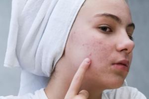 Cara atasi beruntusan pada kulit kombinasi pakai masker dari 4 bahan dapur, wajah auto mulus
