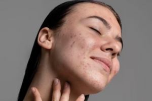 Auto mulus dan lembap, ini cara menghilangkan jerawat pakai overnight mask dari 3 bahan alami