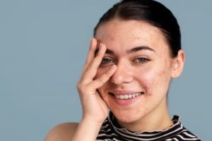 Hanya butuh 1 jenis buah, begini trik atasi wajah breakout agar kembali mulus dan bebas jerawat