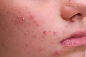 Kulit auto mulus, ini trik merawat wajah iritasi akibat jerawat pakai masker dari 3 bahan dapur