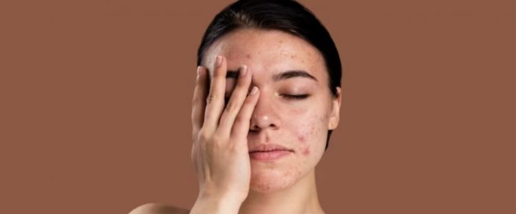 Cara mengatasi peradangan pada jerawat pakai masker dari 1 jenis bumbu dapur, wajah auto mulus