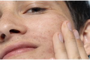 Trik atasi jerawat meradang di wajah pakai peel off mask dari 1 bahan minuman, bikin mulus tanpa bekas