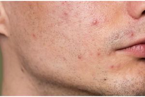 Nggak perlu beli, begini cara membuat acne spot untuk atasi bekas jerawat hanya pakai 1 bahan minuman