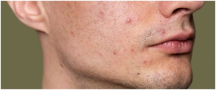 Nggak perlu beli, begini cara membuat acne spot untuk atasi bekas