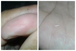 Bukan ditusuk jarum, ini cara cepat mengeluarkan duri ikan di tangan cuma pakai 1 bahan dapur