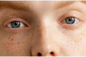 Nggak perlu facial, 9 bahan alami ini bisa bantu atasi hiperpigmentasi wajah