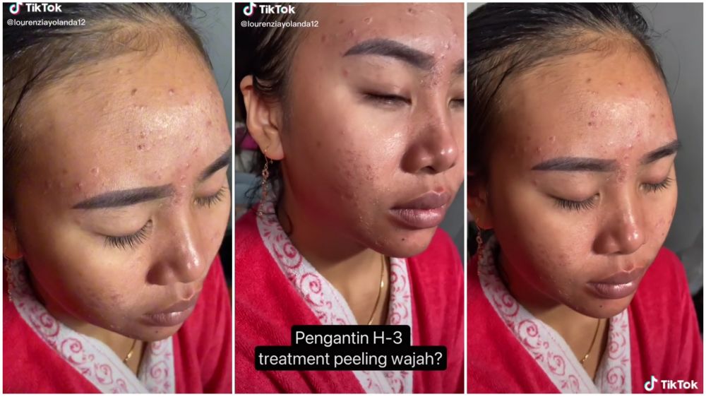 MUA rias wajah pengantin yang berjerawat dan beruntusan H-3 pernikahan, hasilnya bikin nggak nyangka