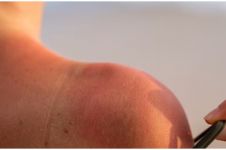 Tanpa bantuan obat, 9 bahan alami ini bisa atasi sunburn agar kulit mulus kembali