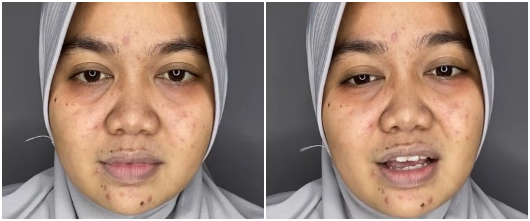 Wanita berjerawat ini automulus berkat makeup, transformasinya dandan soft glam jadi manglingi pol