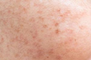 Bukan pakai serum antiaging, ini cara mengatasi pigmentasi efek penuaan pakai 1 jenis sumber protein