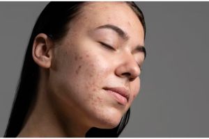 Beri efek mencerahkan, ini trik samarkan bintik hitam pakai 2 bahan dapur