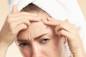 Tak perlu acne patch, ini cara mengatasi jerawat batu membandel pakai 1 bahan pemanis