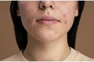 Wajah tak lagi beruntusan dalam semalam, begini trik membuat acne toner dari 1 jenis tanah