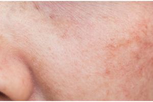 Tak perlu ke dokter, begini cara mengatasi melasma hanya pakai masker dari 1 jenis daun