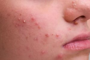 Wajah mulus dalam 3 minggu, begini cara mengeringkan jerawat meradang pakai 2 jenis buah