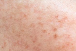 Tak perlu laser, ini trik pudarkan flek hitam agar wajah kembali mulus pakai masker dari 1 jenis buah