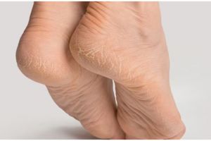 Cara atasi tumit pecah-pecah hanya pakai 1 bahan minuman ini bikin auto kenyal seperti kulit bayi