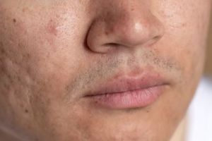 Tak perlu laser, ini cara membuat masker untuk atasi bopeng dan komedo pakai 2 bahan alami