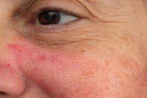 Kulit bebas iritasi, ini cara membuat masker untuk atasi kemerahan pada wajah pakai 1 bahan makanan