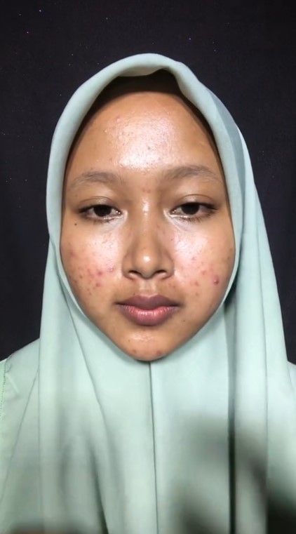 Keajaiban makeup bisa bikin mulus, potret wanita penuh bekas jerawat usai dandan ini bikin susah kedip