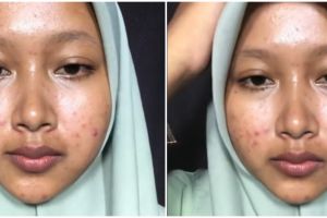 Keajaiban makeup bisa bikin mulus, potret wanita penuh bekas jerawat usai dandan ini bikin susah kedip