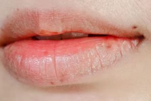 Nggak perlu beli, begini trik atasi bibir kering dan mengelupas pakai lip mask dari 1 jenis minyak