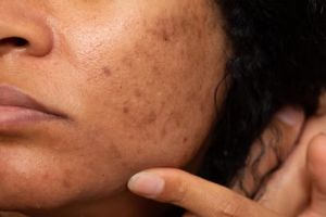 Flek hitam terhempas, ini trik bikin kulit cerah bercahaya cuma pakai 1 buah